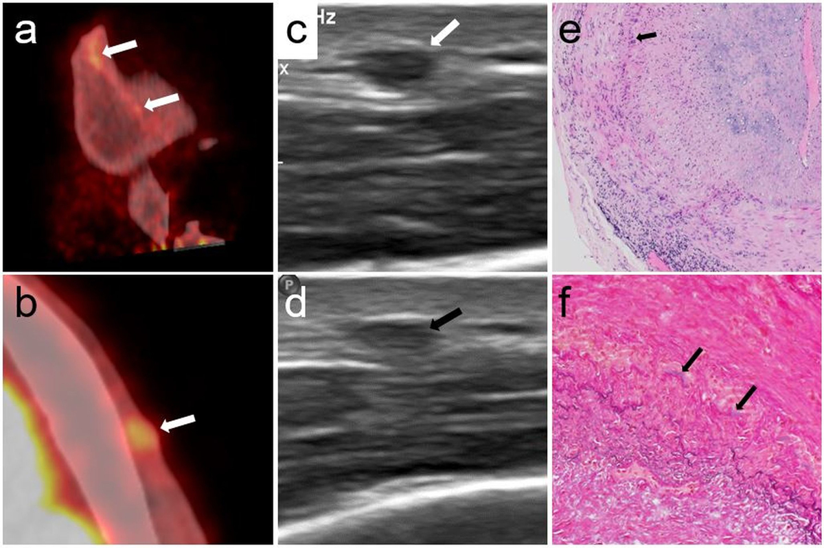 18FFDG PET/CT compared with ultrasound and biopsy for detection of